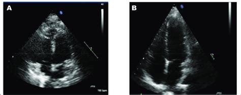 is left ventricular hypokinesis dangerous.